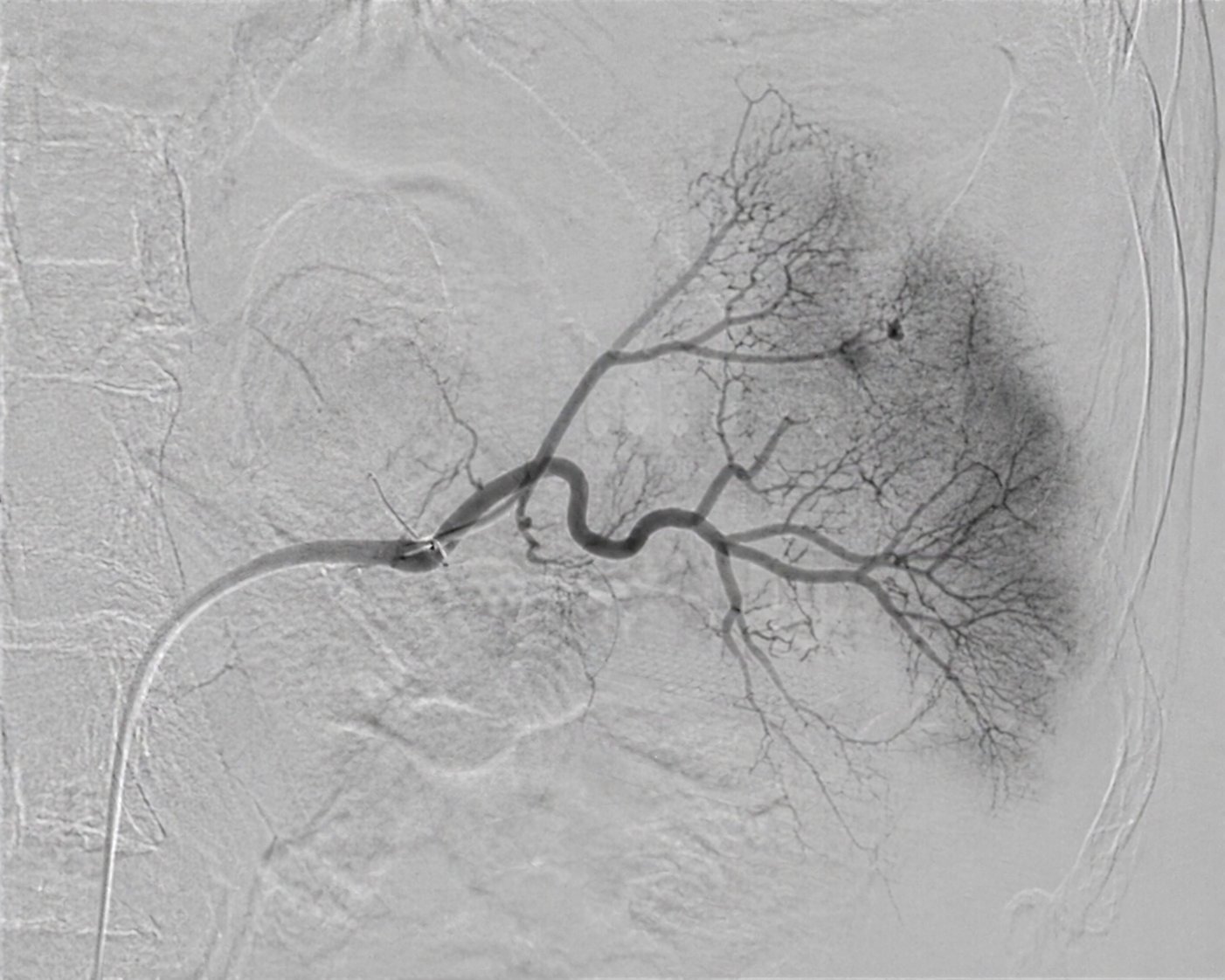 Digital subtraction angiogram of visceral arterial circulation